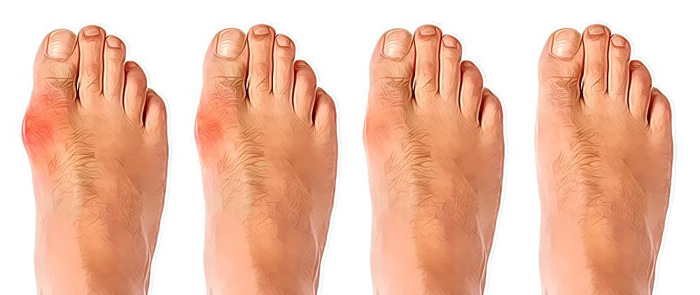 A Simple But Powerful Natural Remedy To Get Rid Of Bunions 