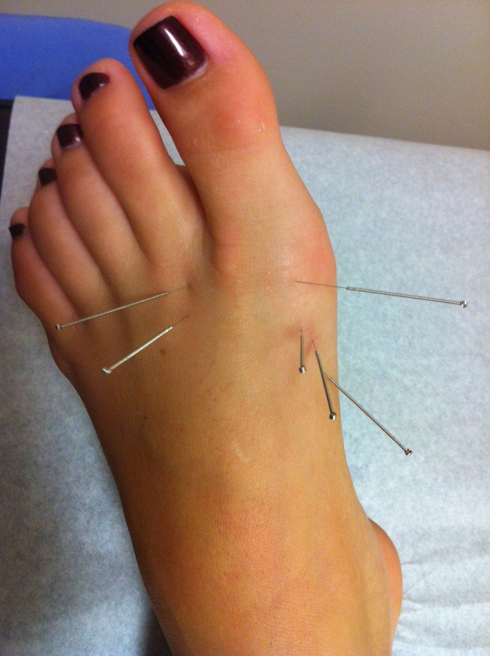 Acupuncture And Gout: Can Acupuncture Really Help With ...