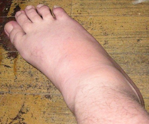 does-gout-cause-ankle-swelling-goutinfoclub