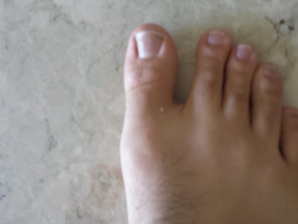 What Can I Do For Gout In My Foot GoutInfoClub