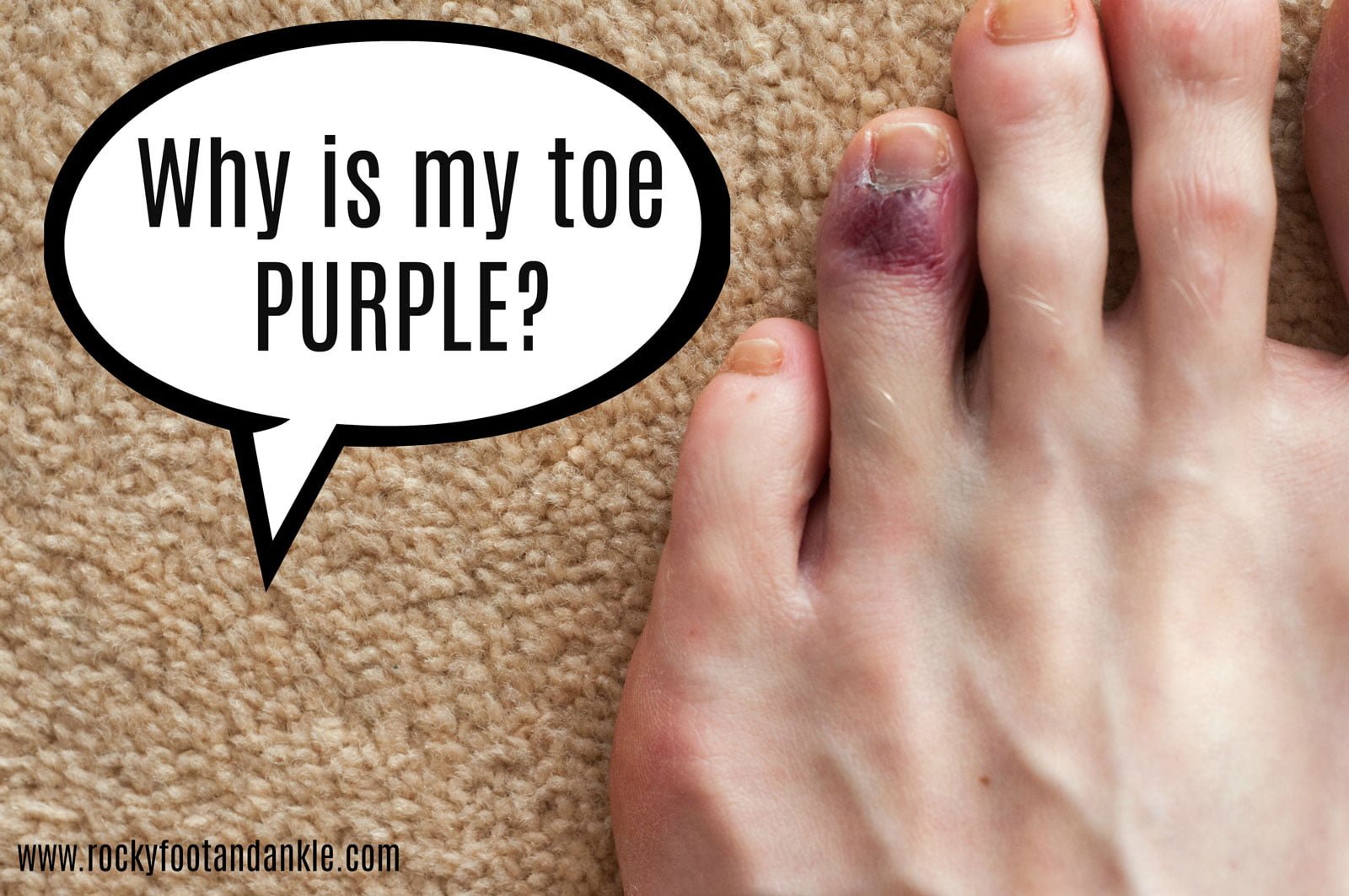 What Does It Mean When Your Toes Turn Black And Blue